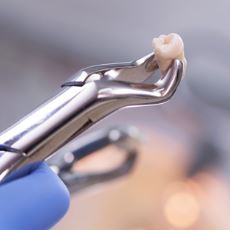 dental extractions canton michigan dentists