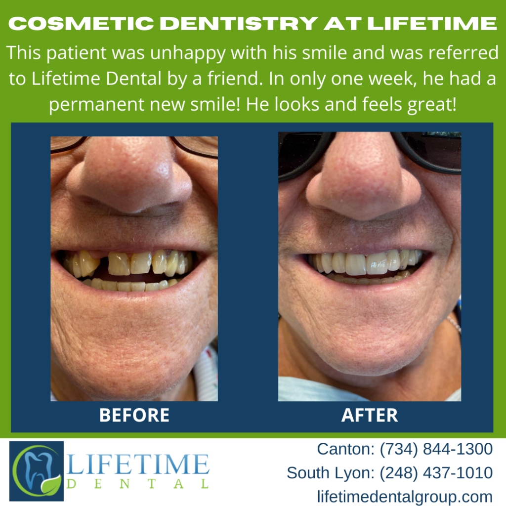 Before After - Missing Tooth - Cosmetic Dentistry